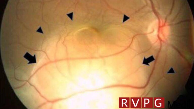 Sudden blindness in a woman's eye turned out to be lung cancer